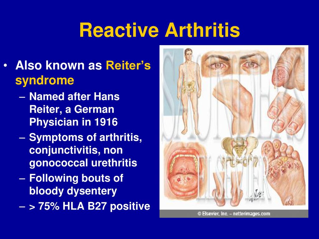 Artritis reactiva tiene cura